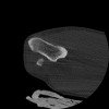 SPORK, NICO - 22.03.1976 - 02.08.2022 - CT obere Extremität - 17:51:17